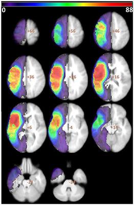 Is Broca's area critical for speech and language? Evidence from lesion-symptom mapping in chronic aphasia